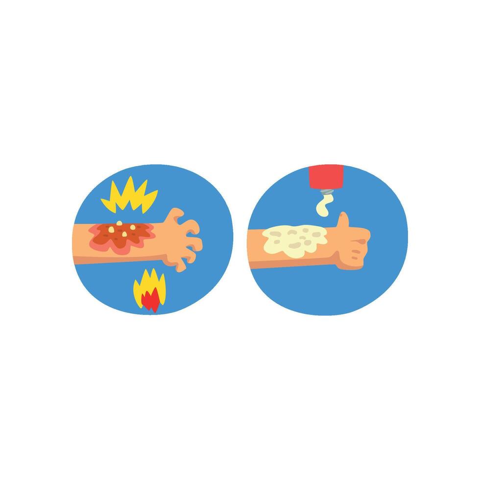 Thermal skin burn of hand, first aid and treatment Illustration on a white background vector
