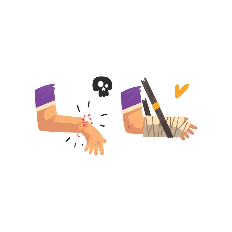 Fracture of the wrist, hand plastered, physical injury, first aid and treatment Illustration on a white background vector
