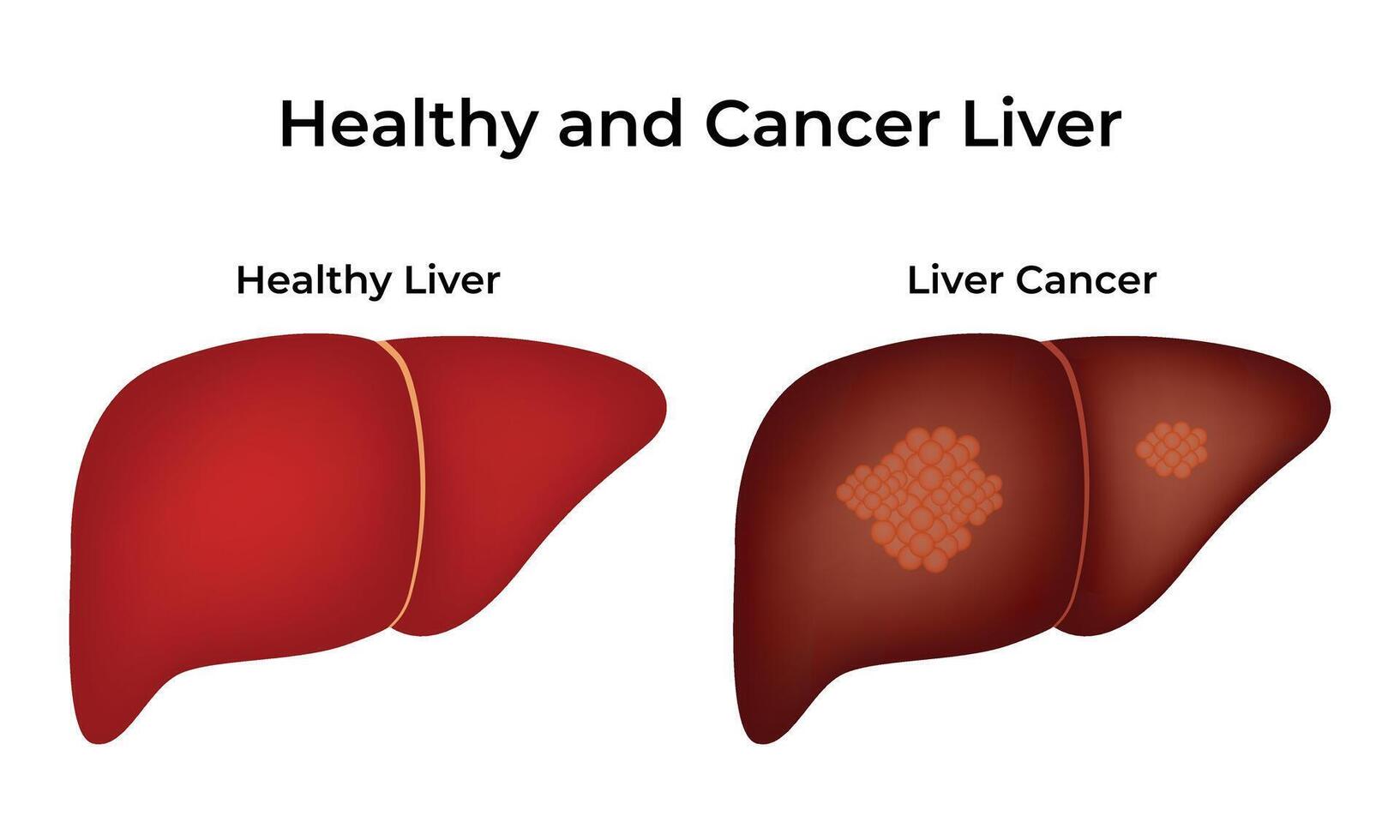 Healthy and Cancer Liver Science Design Illustration Diagram vector