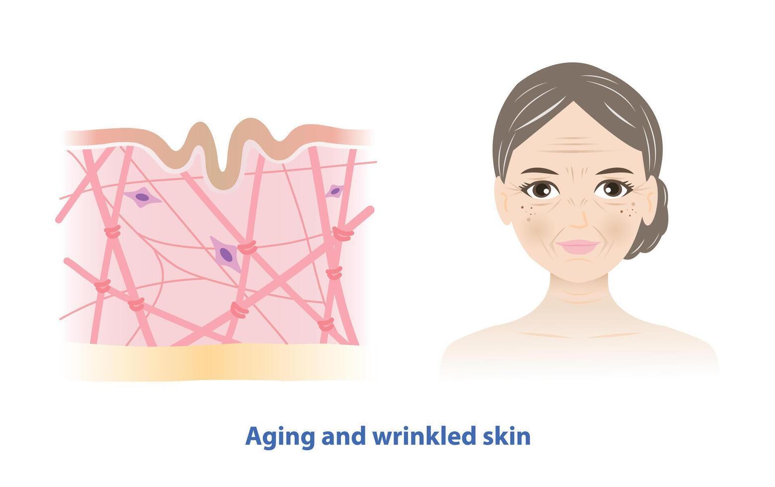 The old woman with aging and wrinkled skin on white background. Cross section of depletion of collagen, elastin fibers and fibroblasts in the dermis layer. Skin care and beauty concept. vector