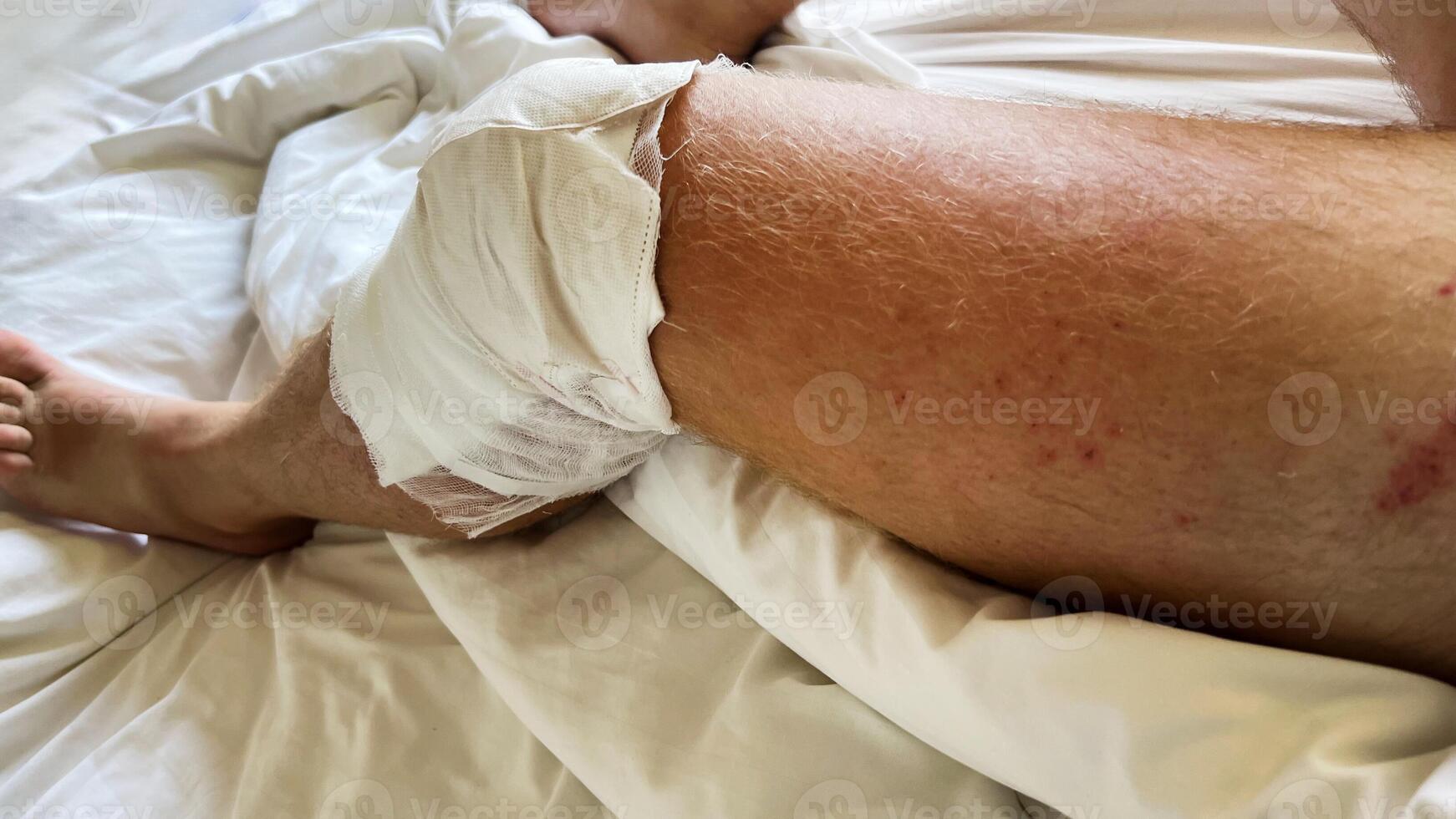 A Caucasian person rests in bed with a bandaged knee, symbolizing recovery and healing from injury or surgery photo