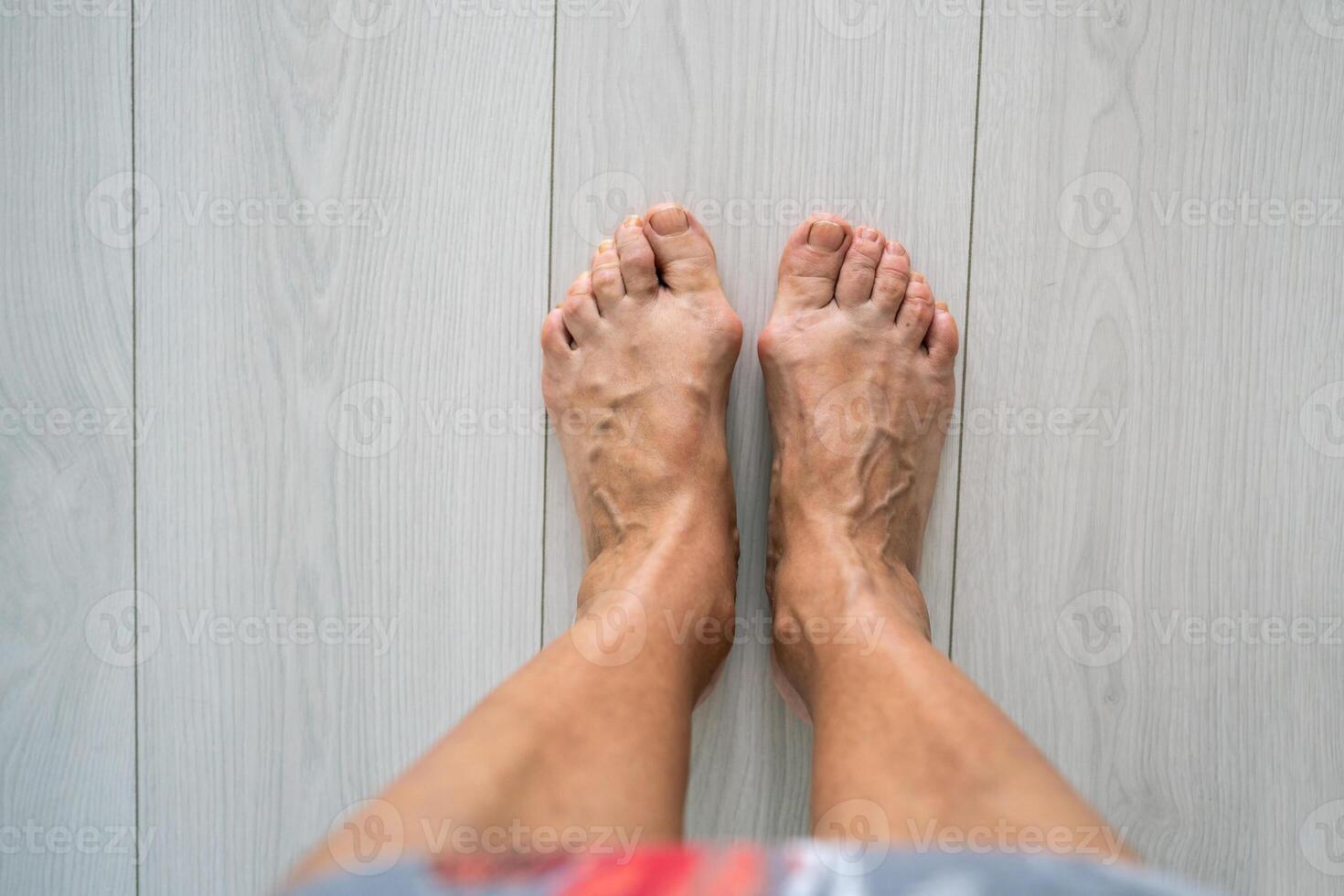 Senior woman varicose bare feet with valgus deformity. Activity pain, orthopaedics need, bunion photo