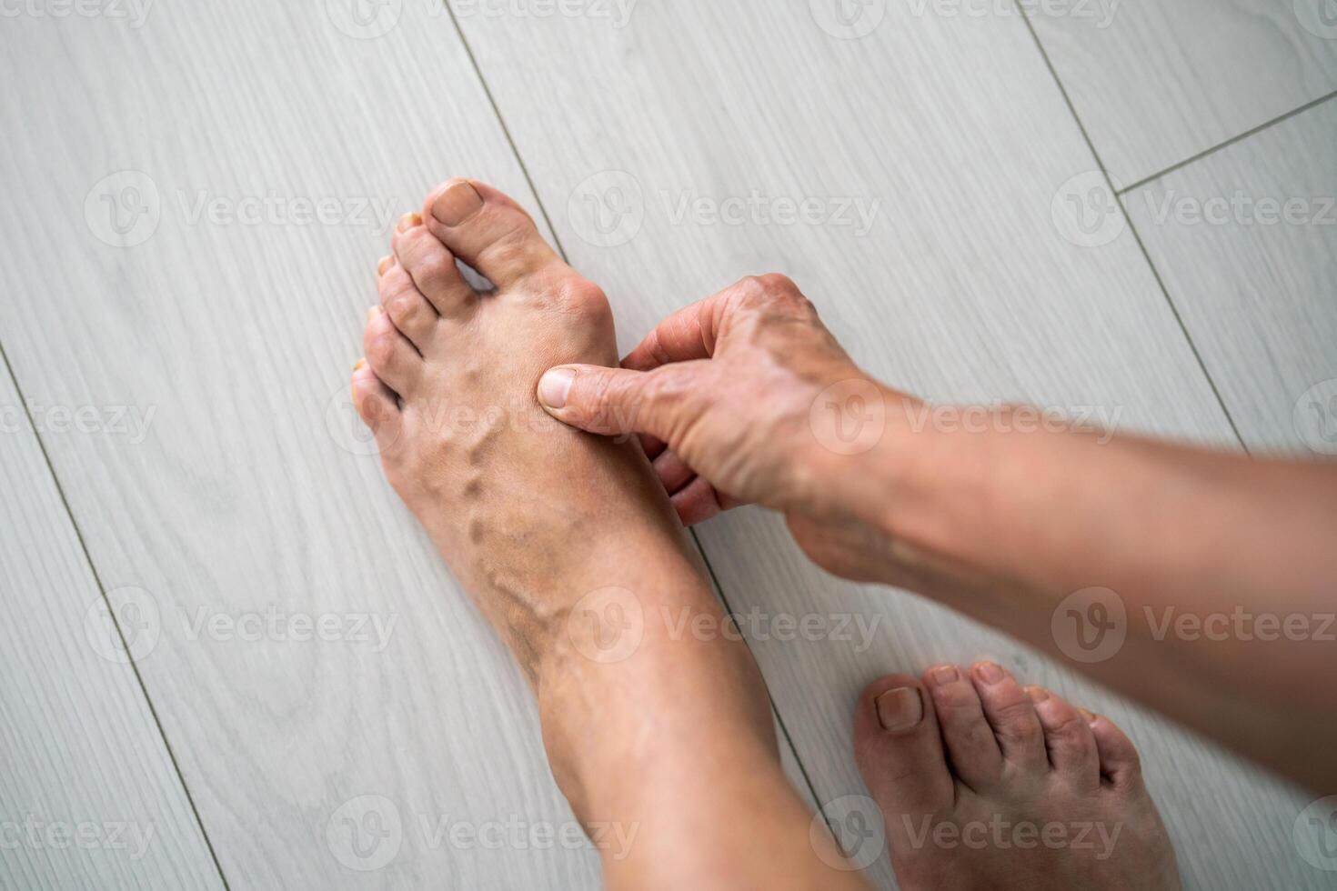 Valgus deformity. Undefined elderly woman hand holding, touching painful varicose foot with bunion photo