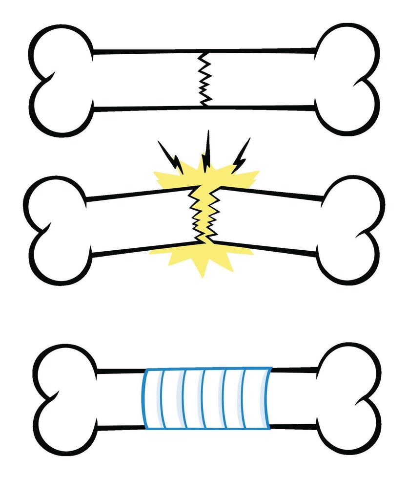 Bone Fracture Line Cartoon Drawing Design. Collection Set - 1 vector