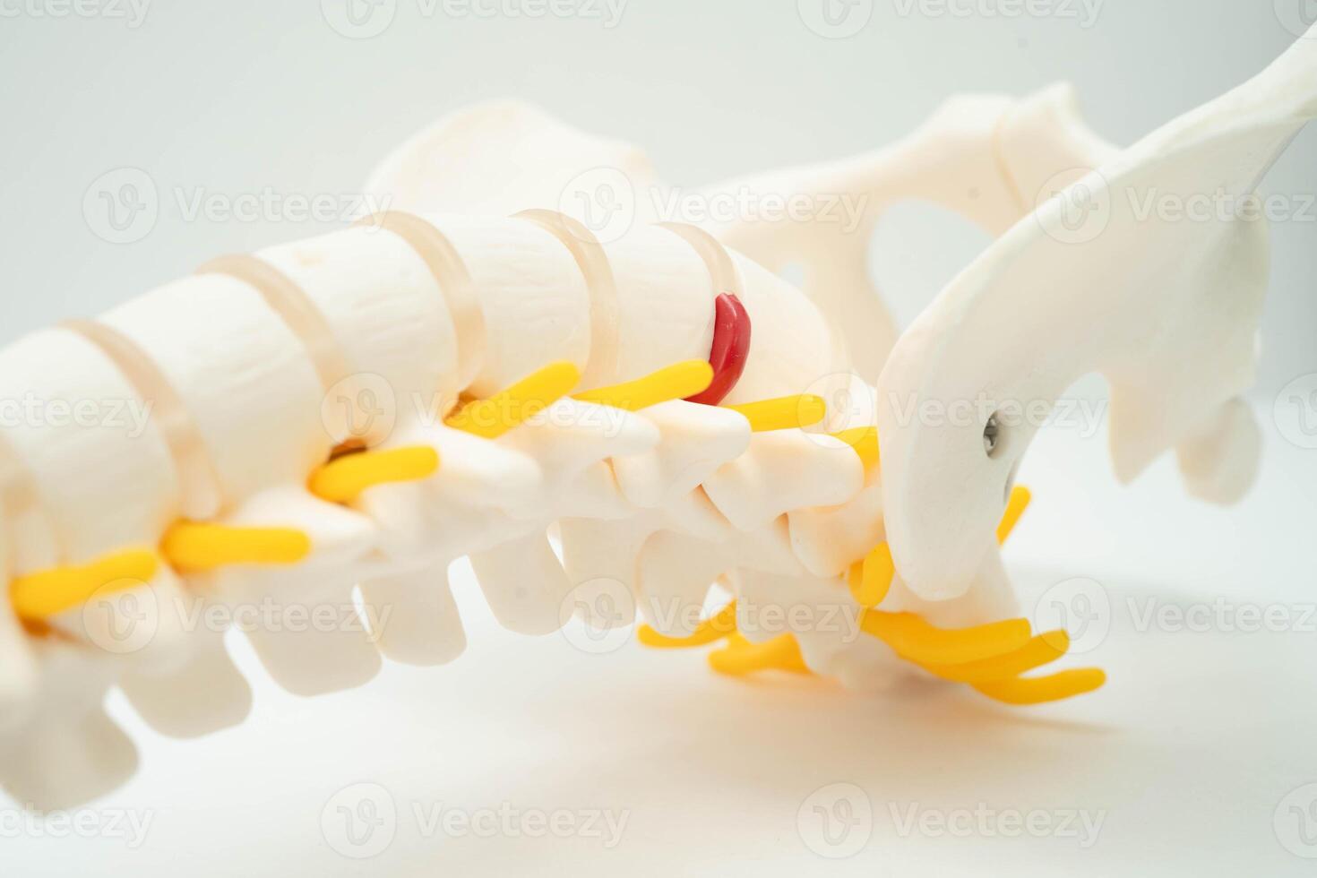 Spinal nerve and bone, Lumbar spine displaced herniated disc fragment, Model for treatment medical in the orthopedic department. photo