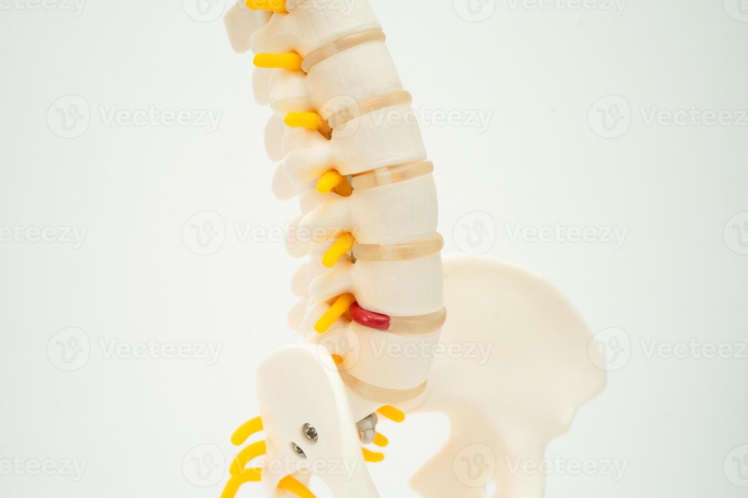 Spinal nerve and bone, Lumbar spine displaced herniated disc fragment, Model for treatment medical in the orthopedic department. photo