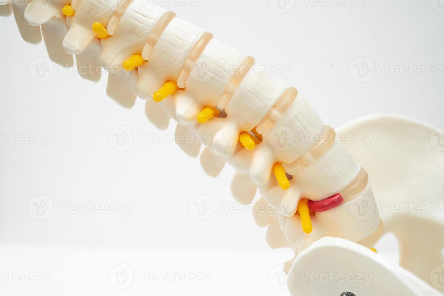 Lumbar spine displaced herniated disc fragment, spinal nerve and bone. Model for treatment medical in the orthopedic department. photo