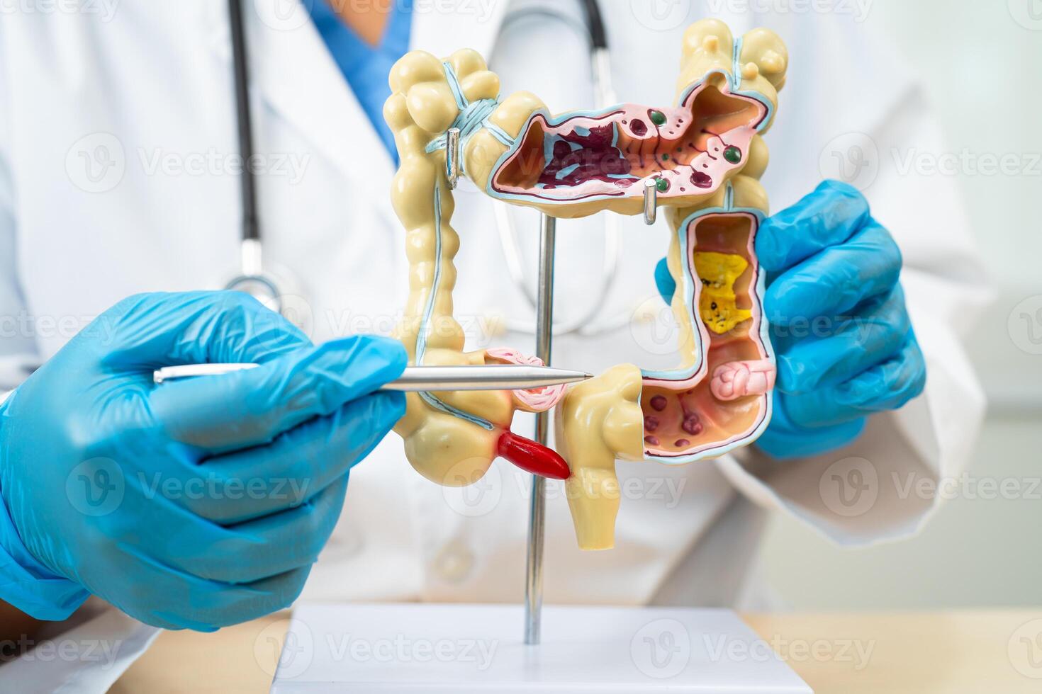 Ulcerative Colitis. Intestine, appendix and digestive system, doctor holding anatomy model for study diagnosis and treatment in hospital. photo