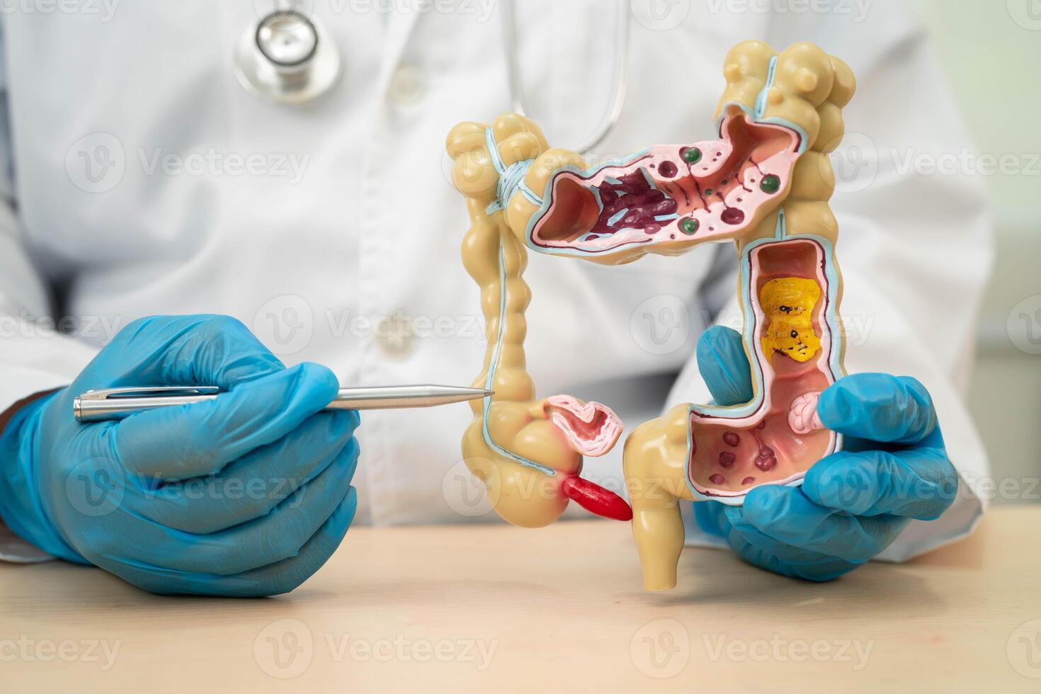 Ulcerative Colitis. Intestine, appendix and digestive system, doctor holding anatomy model for study diagnosis and treatment in hospital. photo