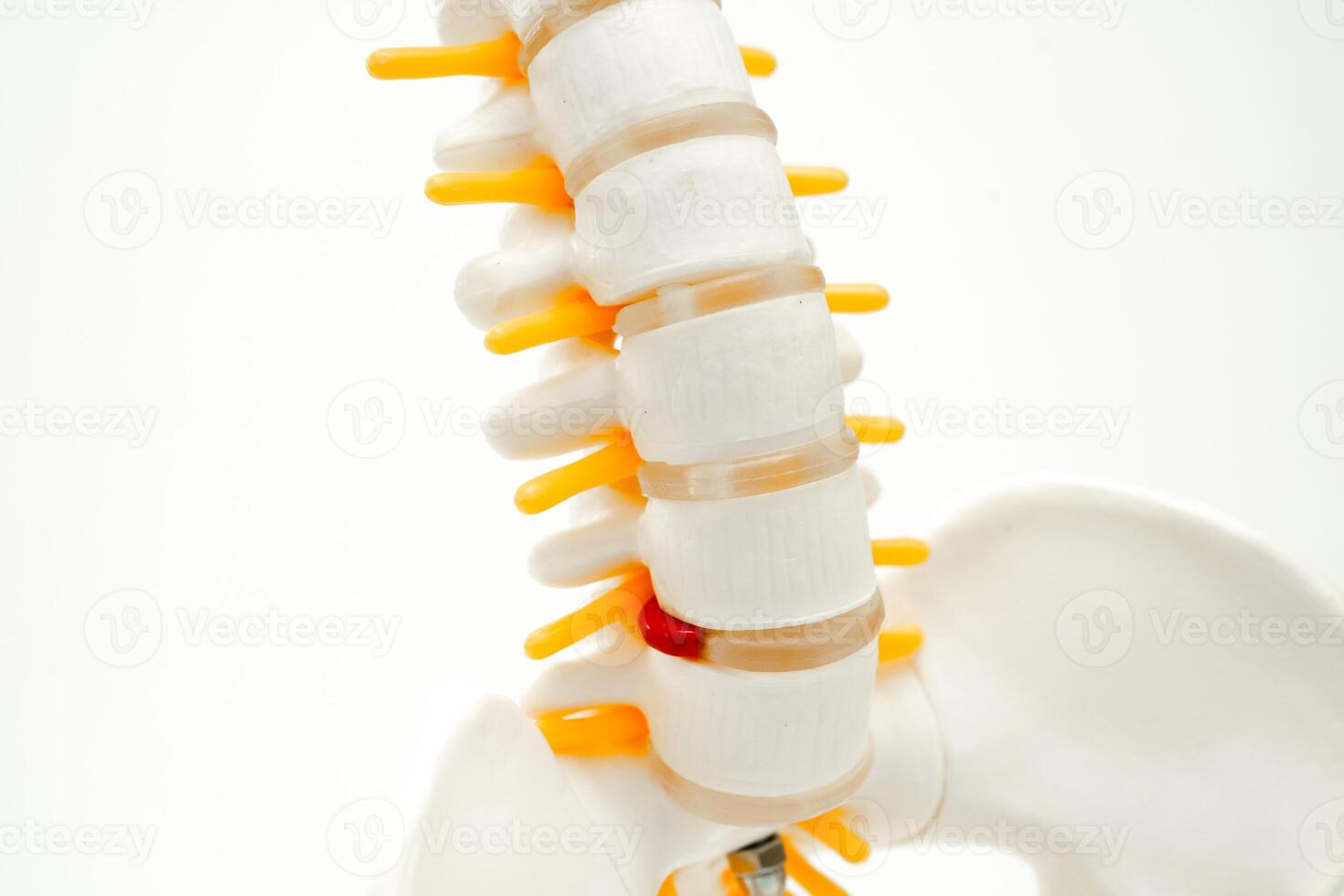 Spinal nerve and bone, Lumbar spine displaced herniated disc fragment, Model for treatment medical in the orthopedic department. photo