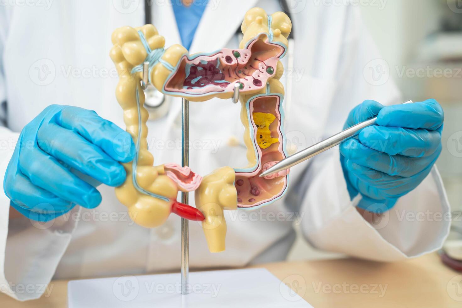 Ulcerative Colitis. Intestine, appendix and digestive system, doctor holding anatomy model for study diagnosis and treatment in hospital. photo