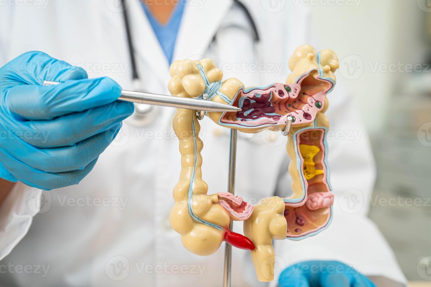 Ulcerative Colitis. Intestine, appendix and digestive system, doctor holding anatomy model for study diagnosis and treatment in hospital. photo
