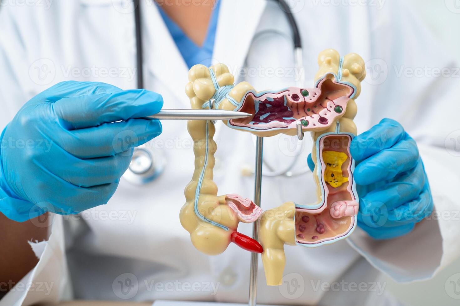 Ulcerative Colitis. Intestine, appendix and digestive system, doctor holding anatomy model for study diagnosis and treatment in hospital. photo