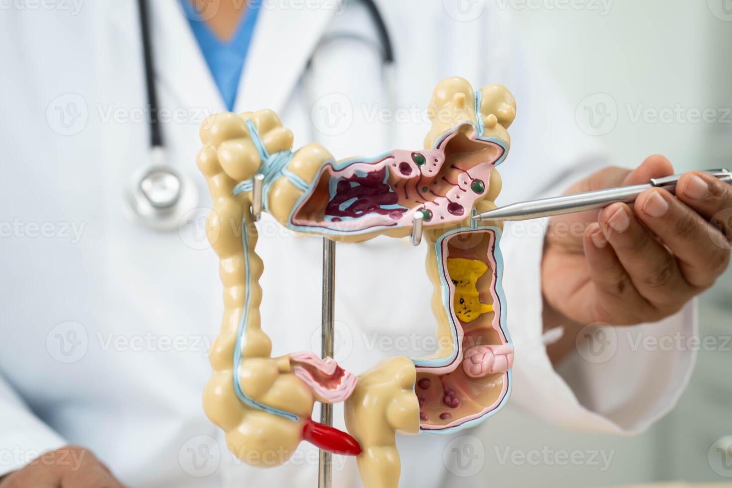 Ulcerative Colitis. Intestine, appendix and digestive system, doctor holding anatomy model for study diagnosis and treatment in hospital. photo