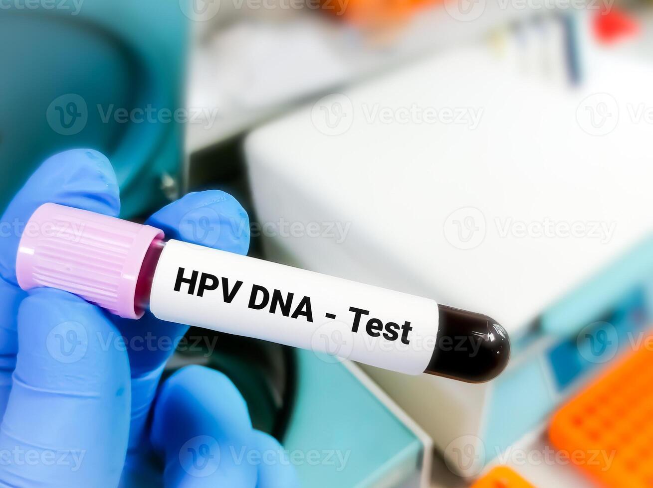 Blood sample for HPV PCR test, human papilloma virus test photo