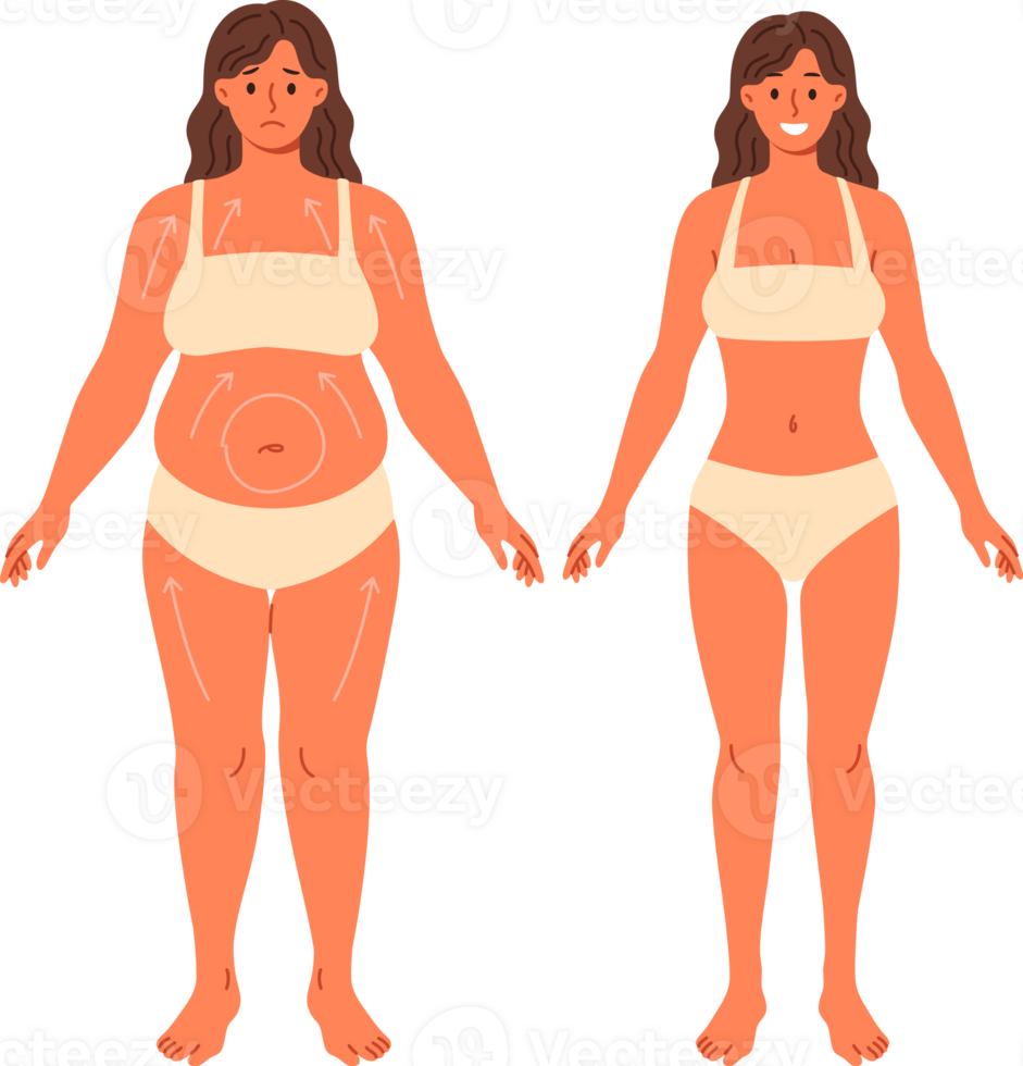 Liposuction for overweight woman posing in underwear before and after surgery. Beautiful girl in need of liposuction demonstrates progress achieved without use of diets and fitness png