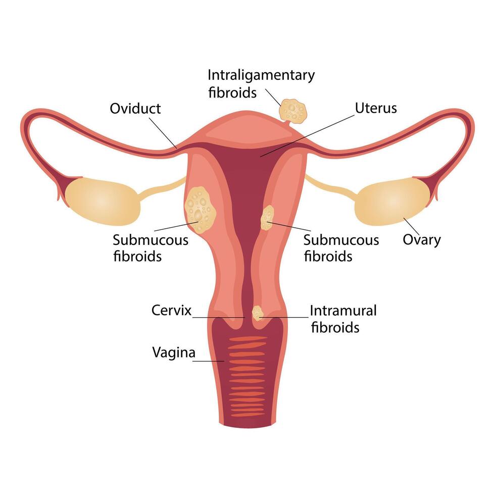 endometriosis, uterine fibroids, gynecological cancer, subserous fibroids and cervical, vaginal vector