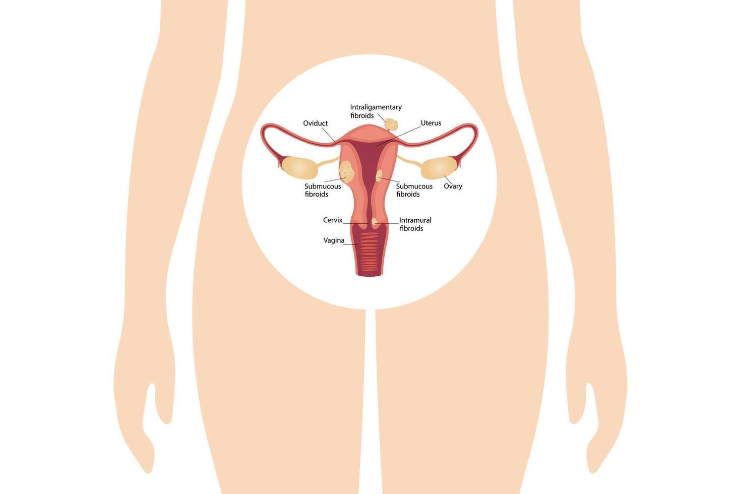 Ovarian and cervical cancer, cervical disorder, endometriosis, hysterectomy, uterine fibroids, reproductive system, menstruation vector