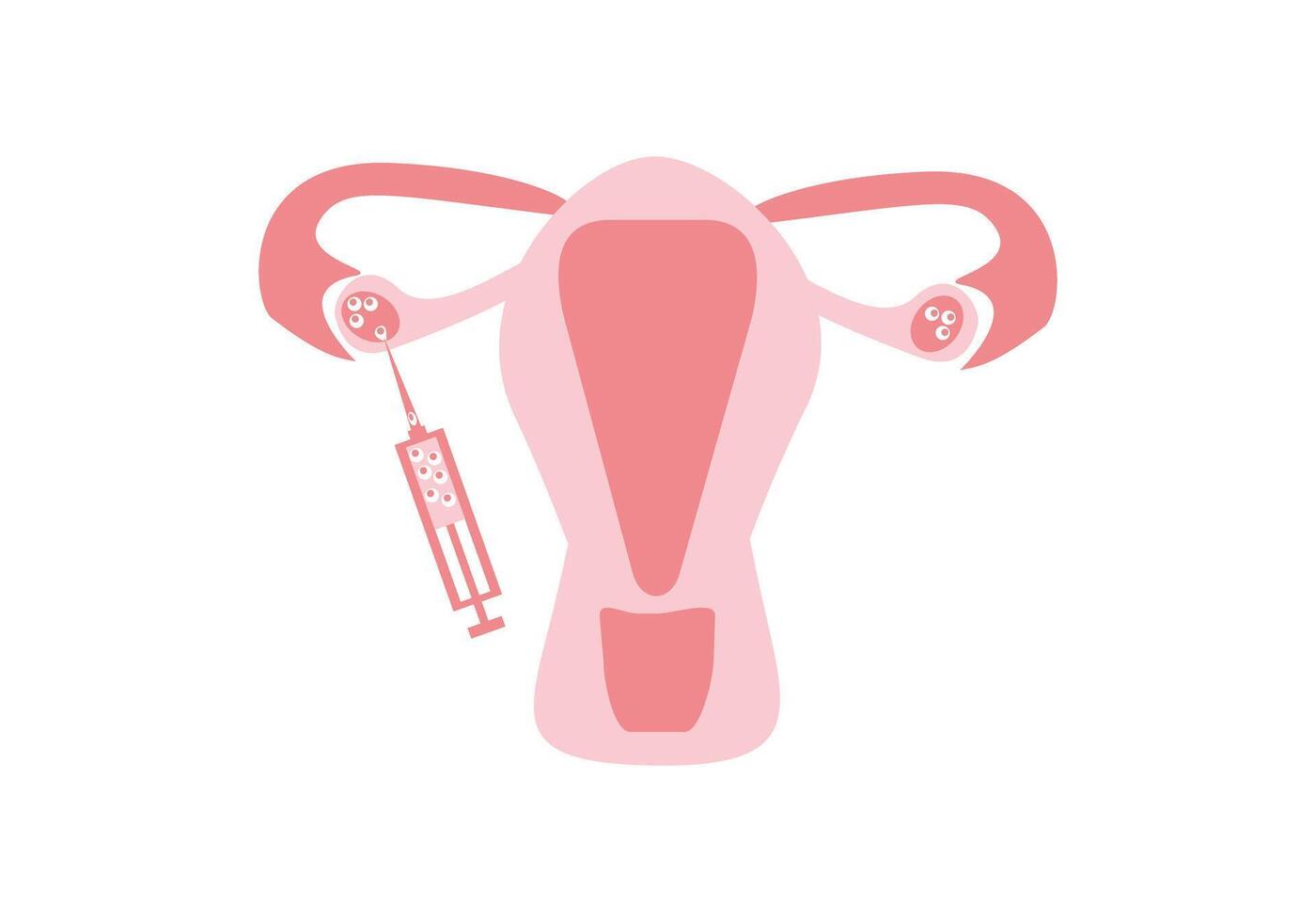 IVF stage, egg puncture, oocyte collection vector