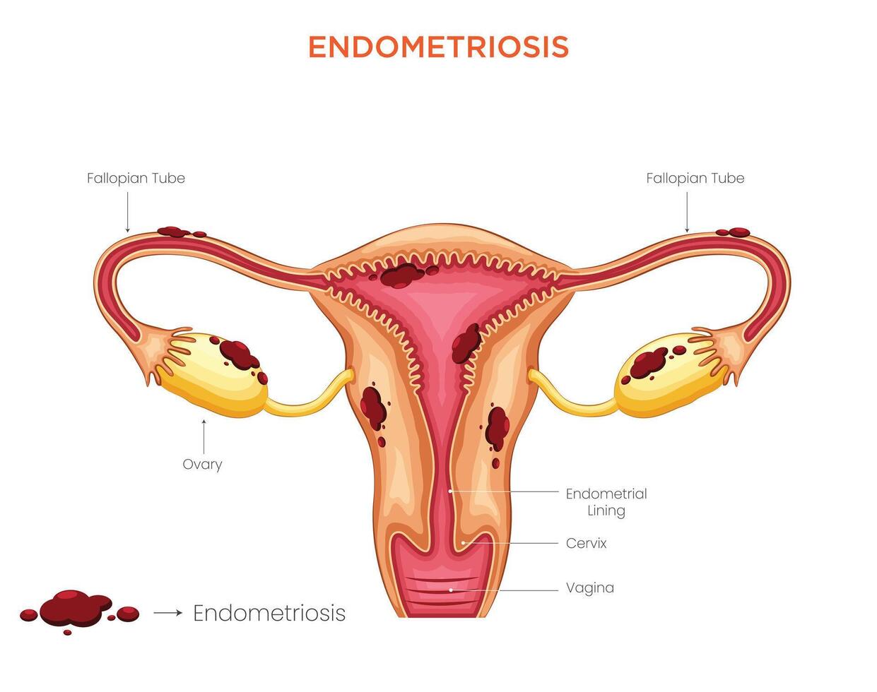 Understanding Endometriosis Causes, Symptoms, and Treatment vector