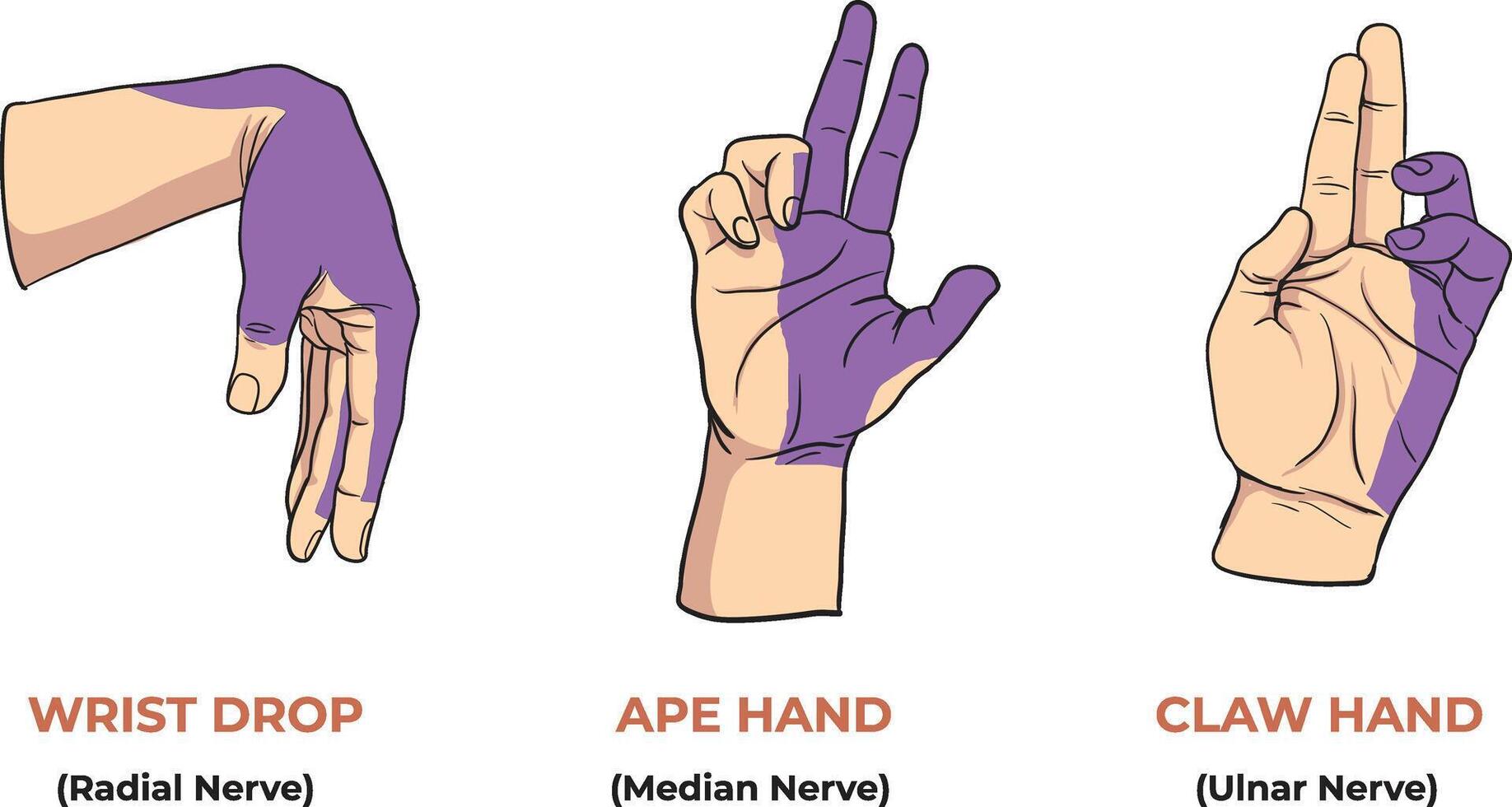 Illustration of nerve injuries in hand vector