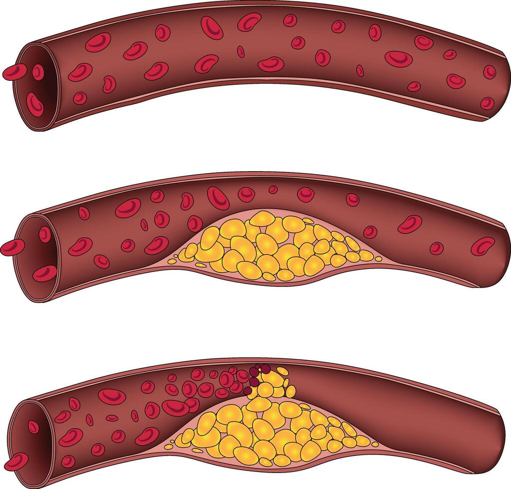 illustration of clogged arteries stage vector