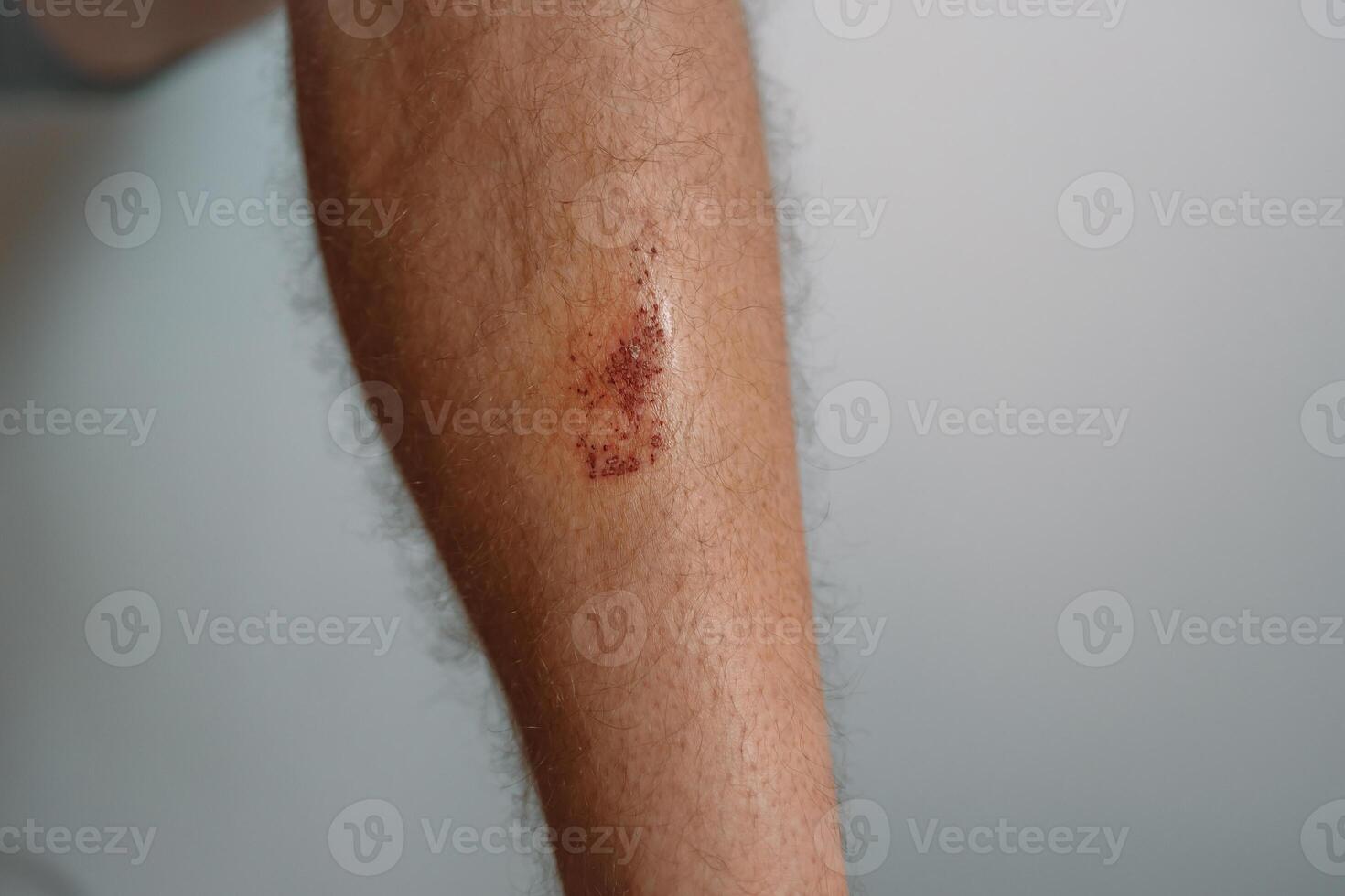 Scratch marks on skin surface cause by sharp fingernails scratching an itch, closeup macro view. Scar on a man's thigh caused by scratching on itchy skin. Healing cut wound on a person's flesh. photo