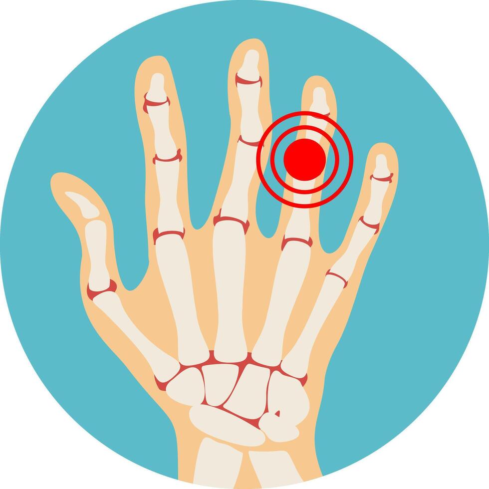 Rheumatoid polyarthritis of hands, arthritis, arthrosis. anatomy of the fingers joints vector