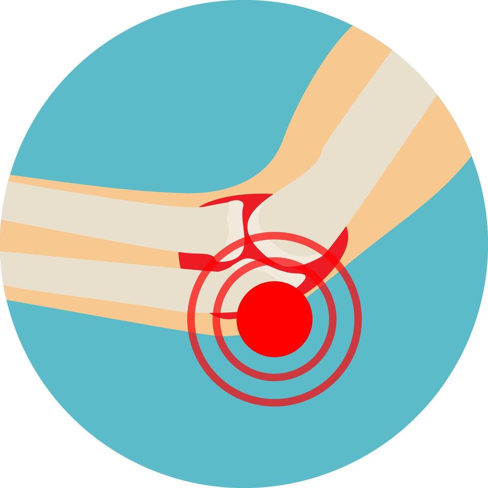 arthritis or arthrosis of the elbow joint. anatomy of the elbow joint. illustration in flat style vector