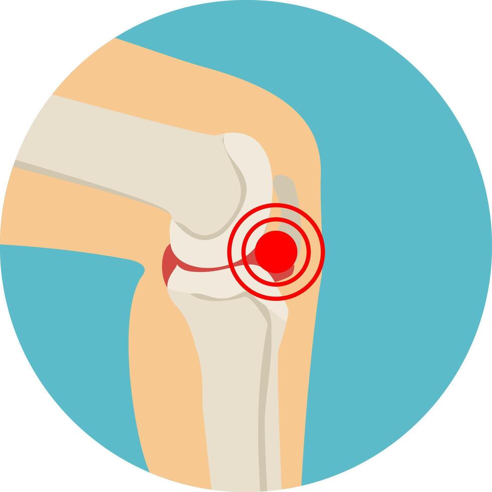 arthritis or arthrosis of the knee-joint. anatomy of the knee joint. illustration in flat style vector