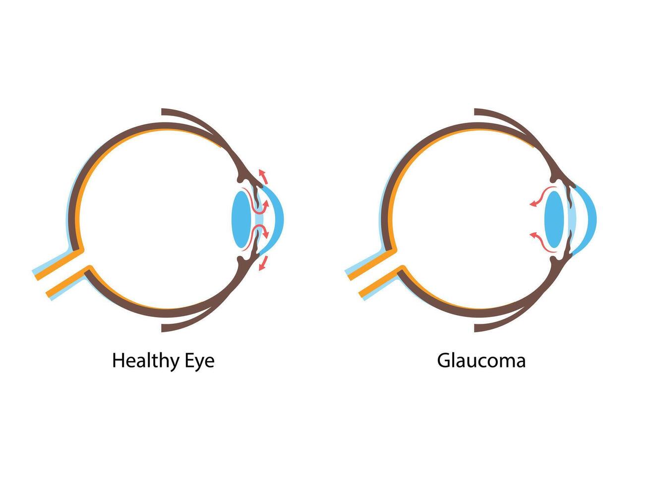 Glaucoma. Increased intraocular pressure, damaged optic nerve, vision loss. Human eye disease illustration vector