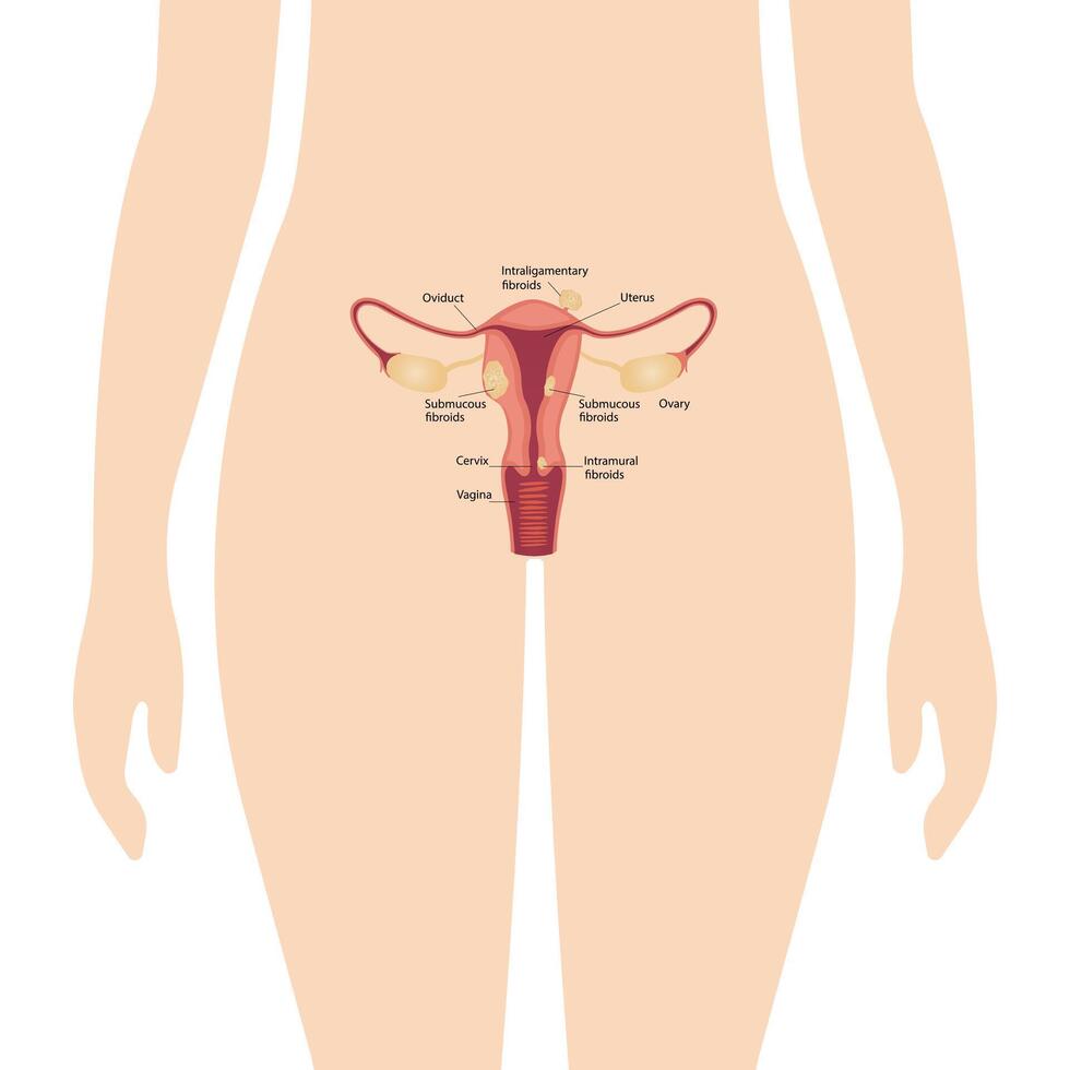 Location of uterine fibroids. Schematic illustration of the uterus, diseases of the female reproductive system vector
