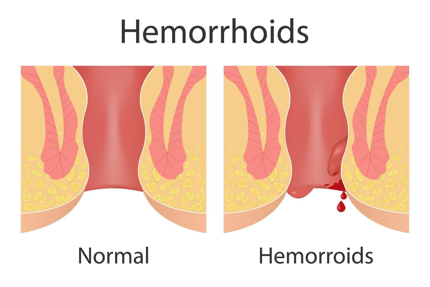 hemorrhoids and inflammation cause bleeding through the fistula patient vector
