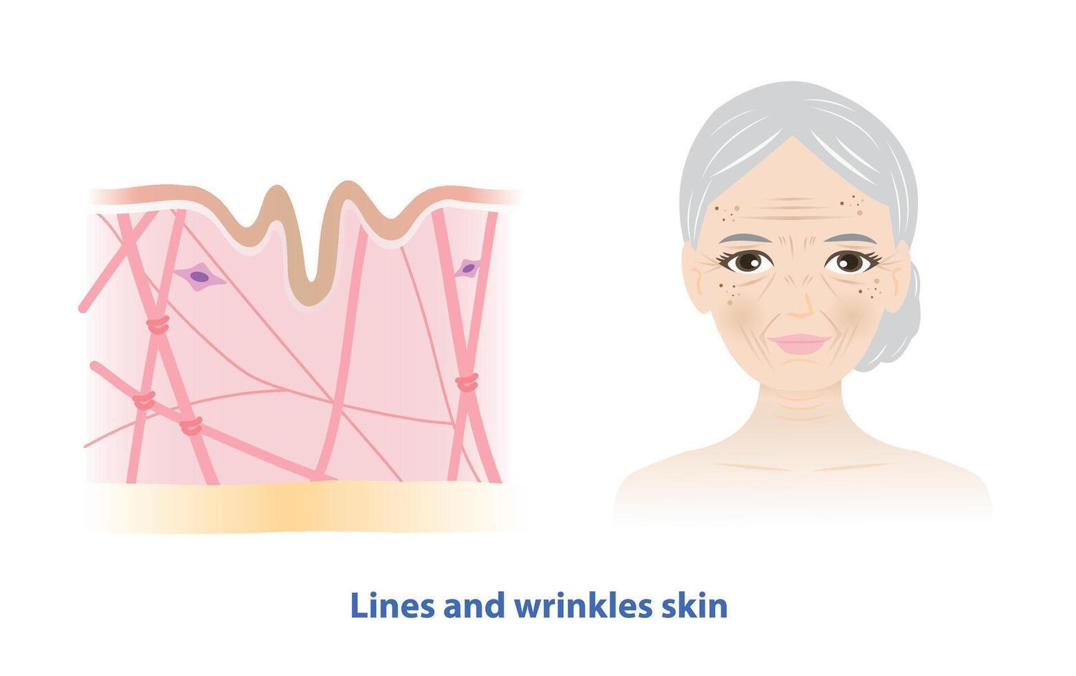 The old woman with lines and wrinkles skin on white background. Cross section of low density of collagen, elastin fibers and fibroblasts in the dermis layer. Skin care and beauty concept. vector