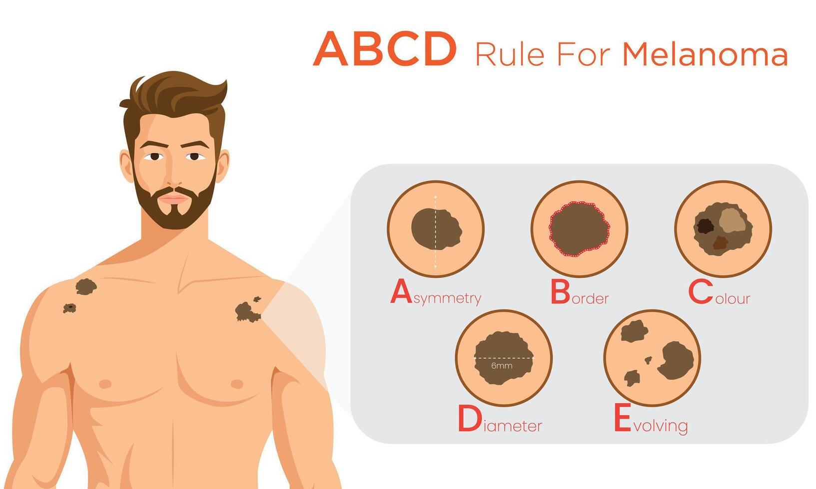 ABCD Rule for Melanoma Identifying Asymmetry, Border, Color, and Diameter Changes vector