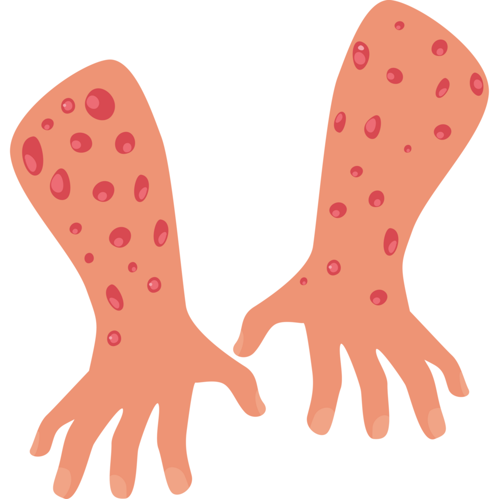 human hands with monkeypox virus png