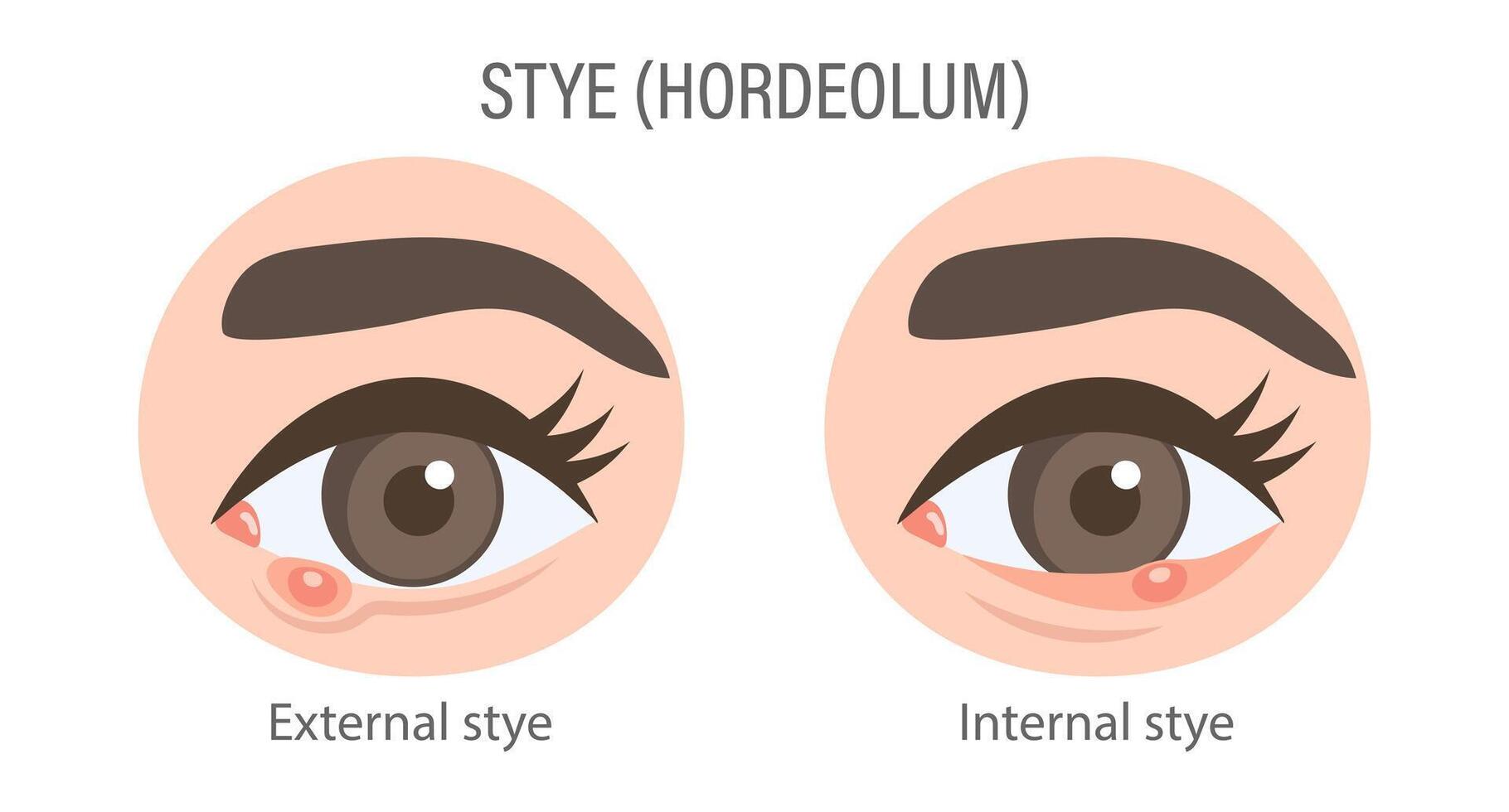 External and internal stye of the eye. Medical concept of stye, eye pain, bacterial infection, eye disease. Flat illustration, infographic banner vector