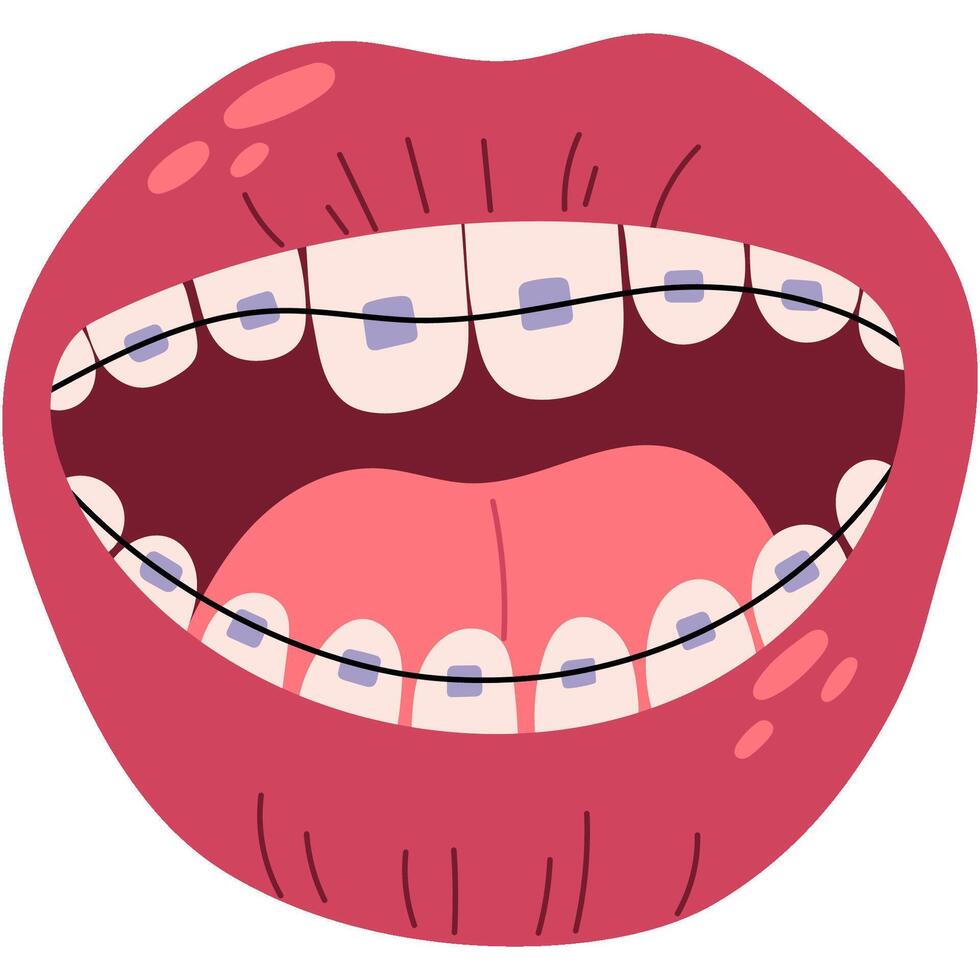 Braces on the teeth. Open mouth with braces. Healthy lifestyle and dental care. vector