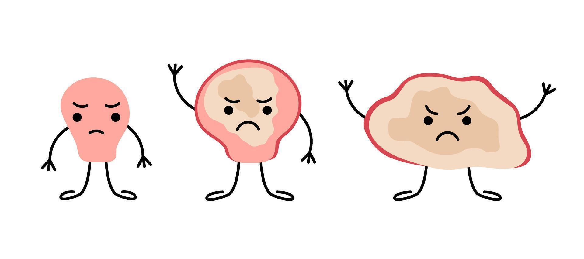 Stage of growth polyp from small in big danger character. Malignant tumor inside wall of human organ. Risk cancer human digestive system organ. Colon cancer cells. Flat illustration vector