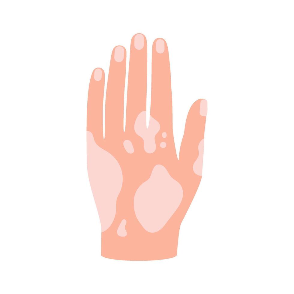 Vitiligo on skin of hand. Body with area pigmentation different color. Autoimmune disease illustration vector