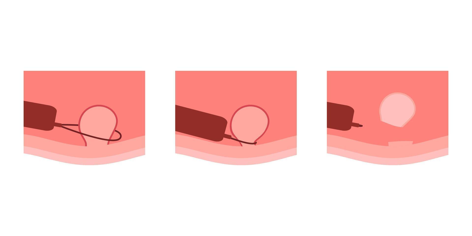 Stage removal polyp in colon, colonoscopy intestine, polypectomy procedure. Checkup gut, colon surgery. Operation intestine. flat illustration vector