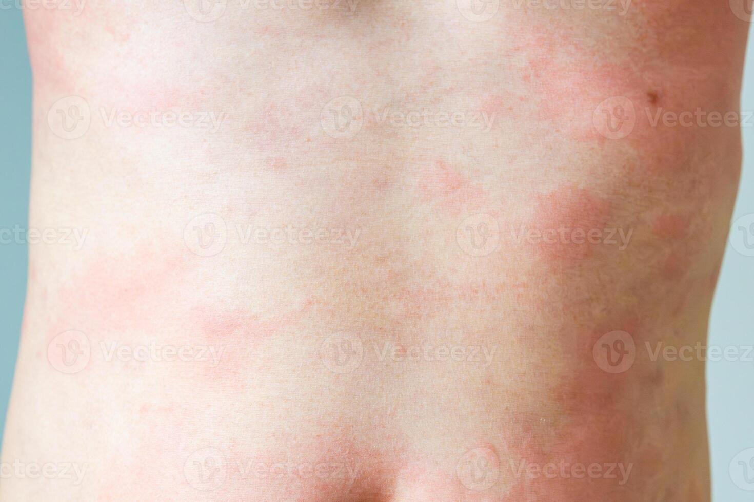 Young asian man itching and scratching on his back from allergic itchy dry skin eczema dermatitis insect bites photo