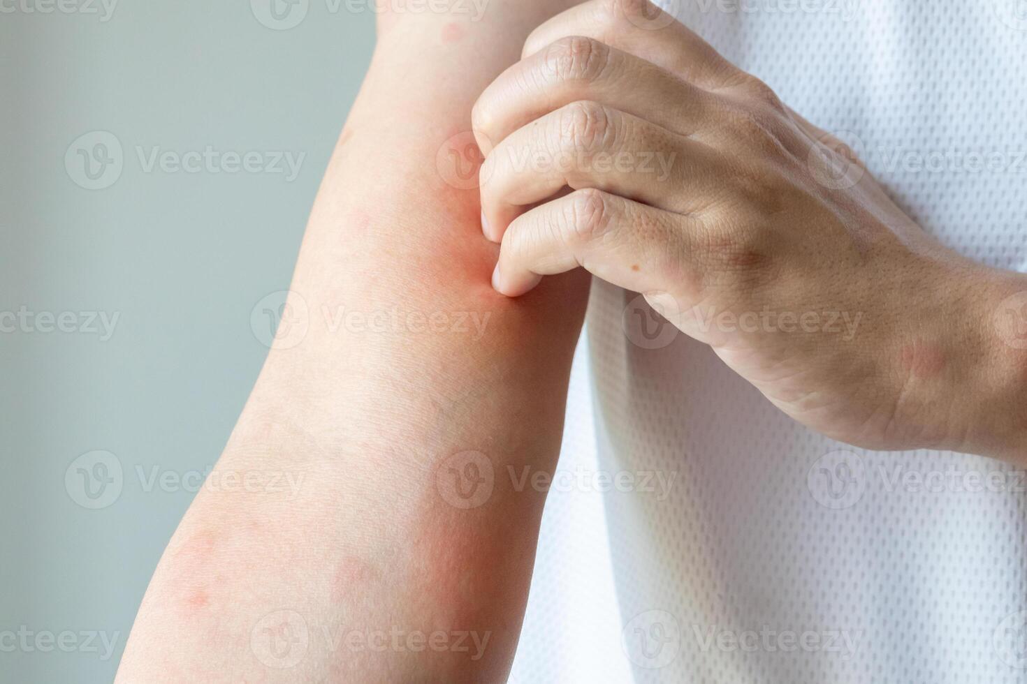 Young asian man itching and scratching on arm from allergic itchy dry skin eczema dermatitis insect bites photo