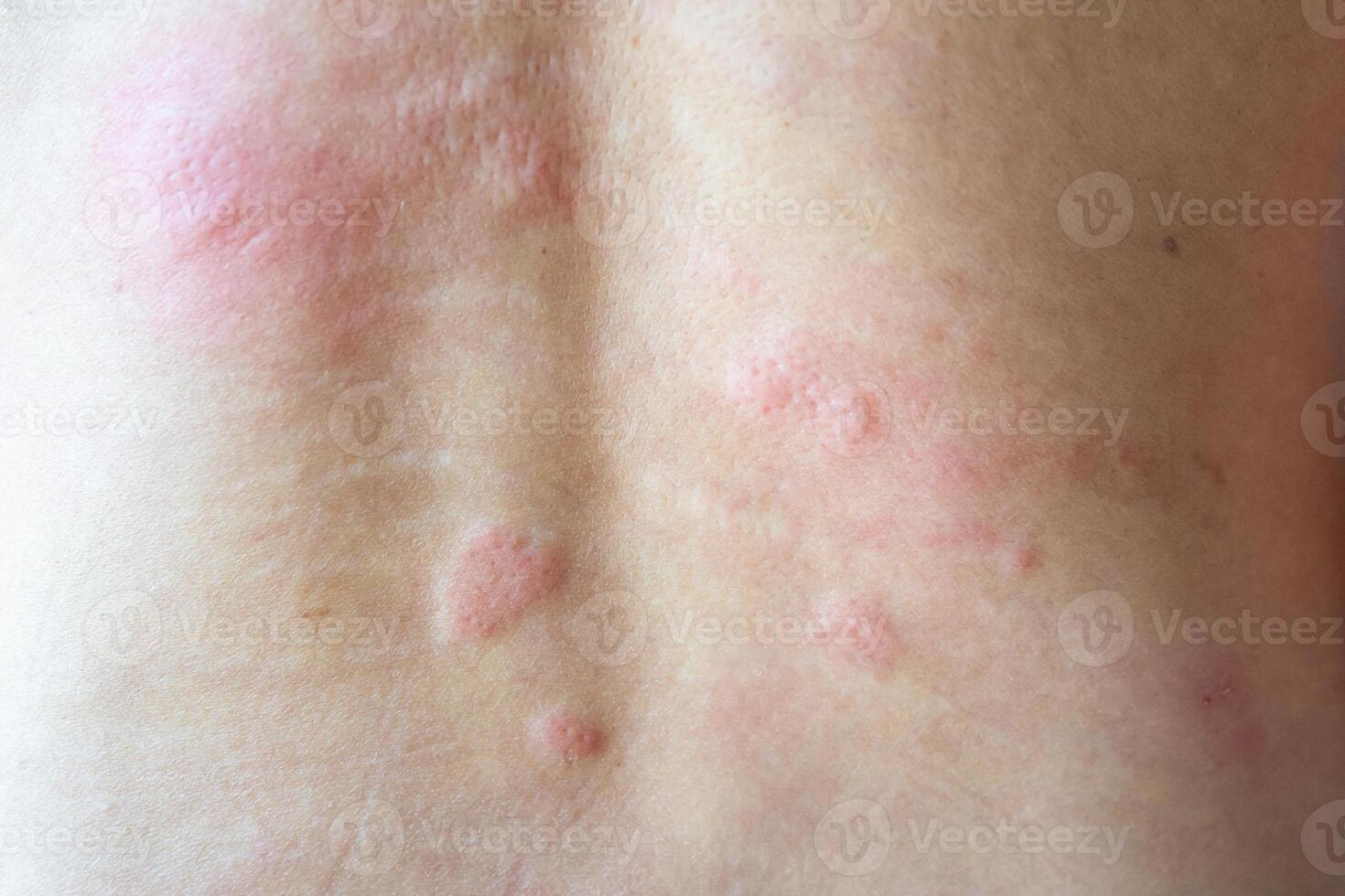 Young asian man itching and scratching on his back from allergic itchy dry skin eczema dermatitis insect bites photo