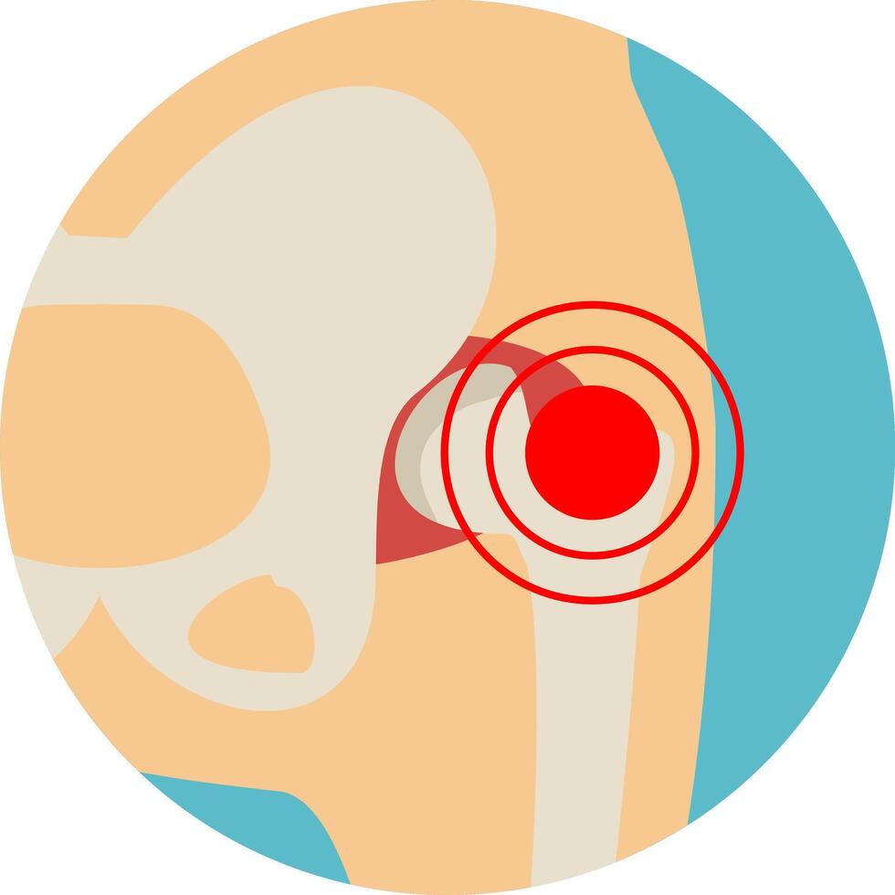 Hip joint structure. Arthritis of the hip joint. Hip Osteoarthritis Icon. Pain, fracture or inflammation in pelvis. Front view vector