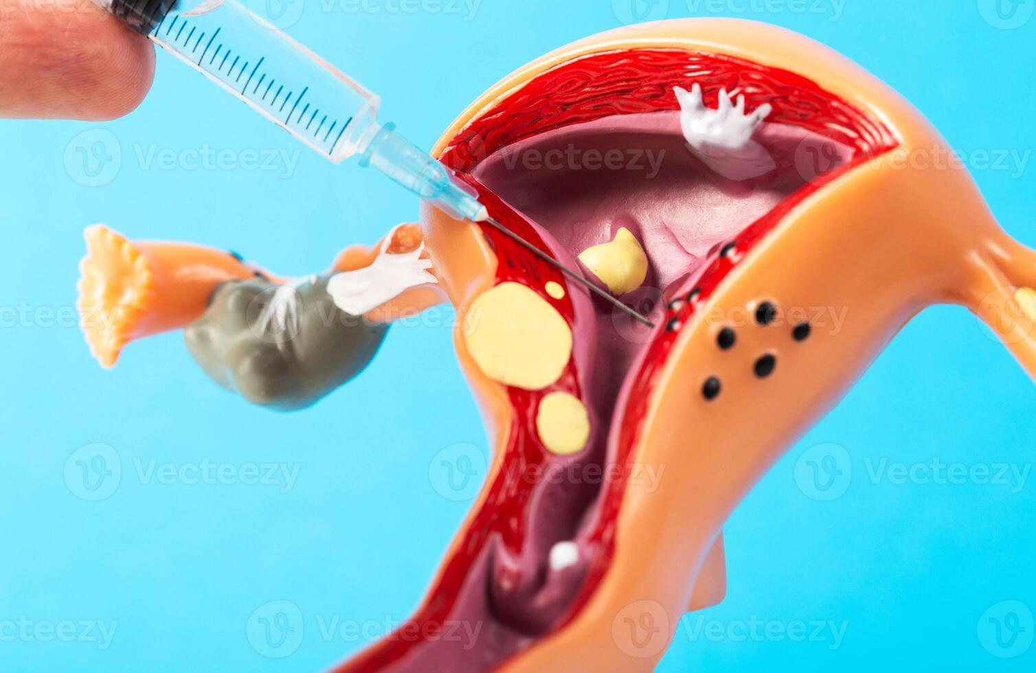 Injection into a medical mockup of the female reproductive system on a blue background. The concept of intimate plastic surgery and plasma lifting. Hylauronic acid injections, G point enlargement photo