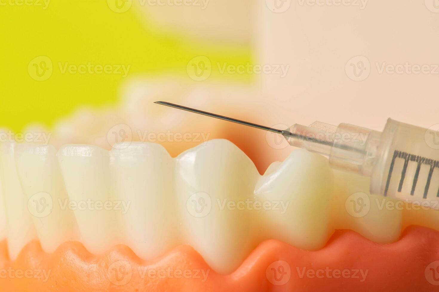 Injection of an anesthetic drug into the gum of a diseased tooth for treatment and surgery. Dental anesthesia in dentistry, freezing, macro. Copy space for text photo