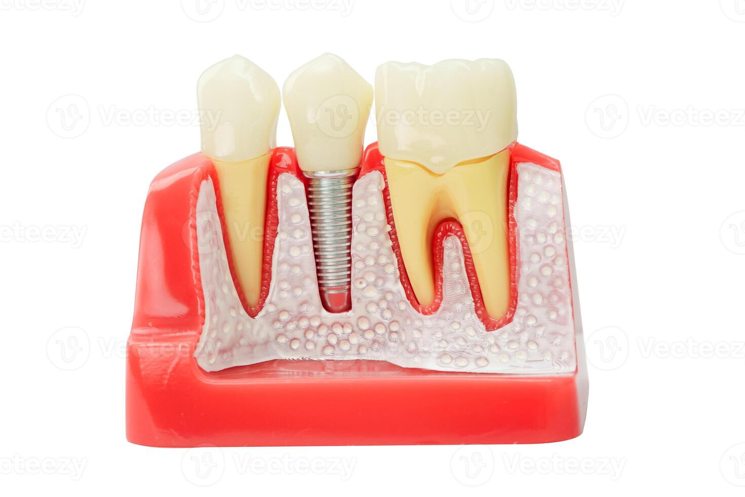 Dental implant, artificial tooth roots into jaw human model isolated on white background with clipping path. photo