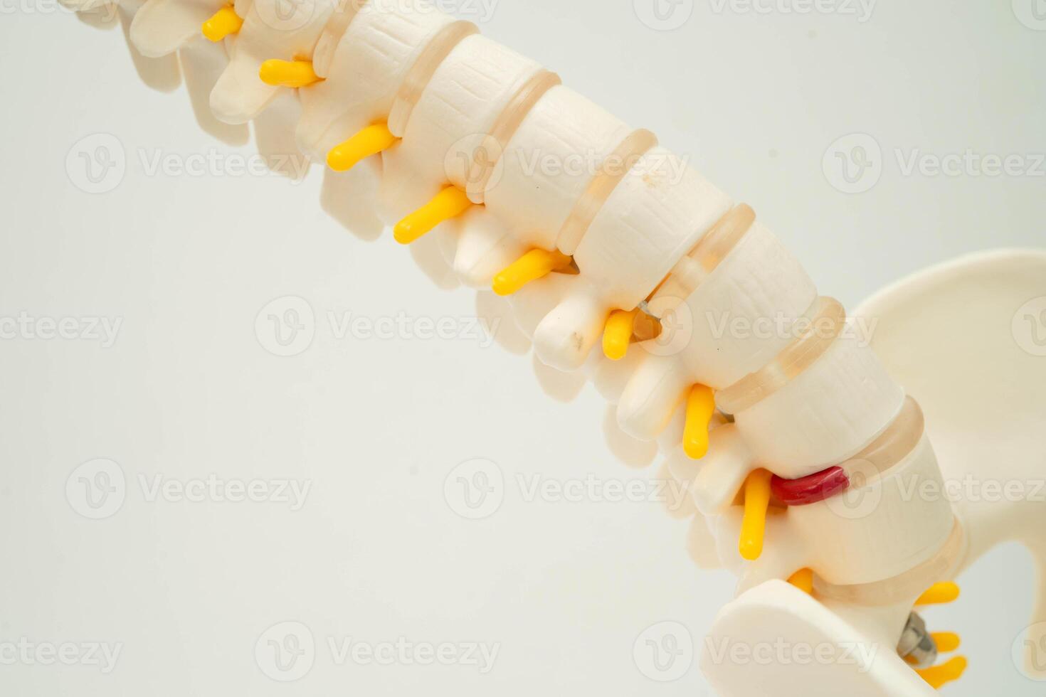 Spinal nerve and bone, Lumbar spine displaced herniated disc fragment, Model for treatment medical in the orthopedic department. photo