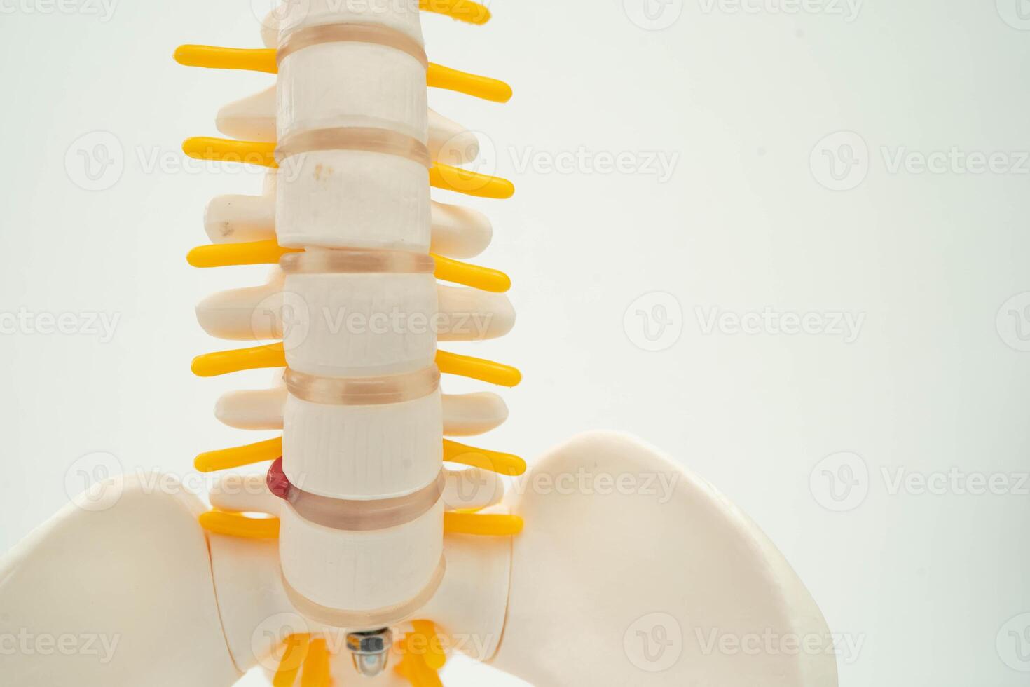 Spinal nerve and bone, Lumbar spine displaced herniated disc fragment, Model for treatment medical in the orthopedic department. photo